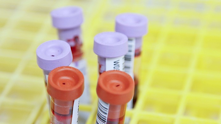 Sechs Blutproben stecken in einem Laborgefäß. 